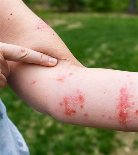 Can Bad Poison Ivy Cause Erectile Dysfunction .